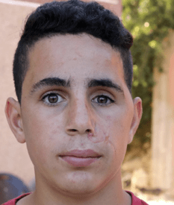 Mohammad Tamimi, after reconstructive surgery in South Africa
