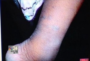 The scarred and swollen ankle of the shackled girl. NBC24 image of courtroom exhibit. Screencap