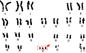 a drawing of the genes of a person with Down Syndrome. The 21st chromosome, with three copies instead of a pair, is highlighted in red