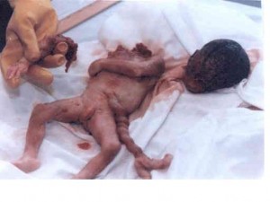 abortion1