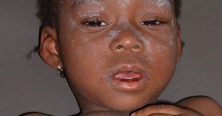 Image result for someone with measles africa