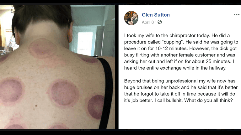 This Is What Happens When A Chiropractor S “cupping” Goes Wrong David Gee