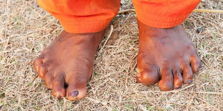 Sakshi's feet still bear the marks of leprosy, though she is now cured.