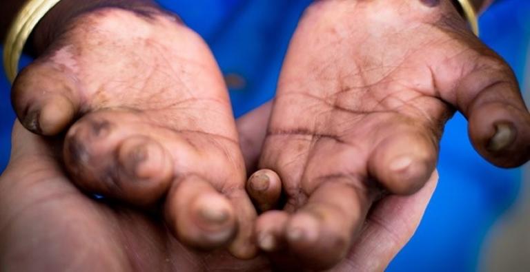 Prina was a living a double-portion of a nightmare... After contracting leprosy, her husband was murdered in a land dispute, leaving Prina a quarantined widow. As the physical symptoms of Prina's leprosy spread, so did the news of her disease among her relatives and other villagers.