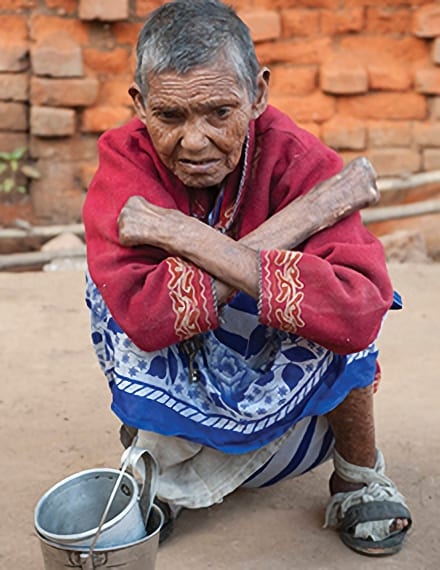 Discussing the discrimination leprosy patients experience, and the grace of God through leprosy ministry missionaries to help and heal the uncared for and shunned.