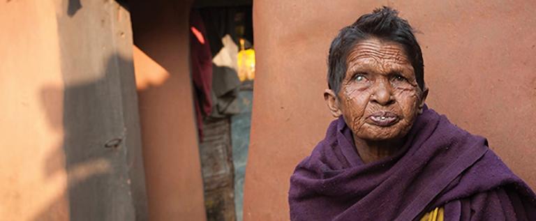 Discussing the discrimination leprosy patients experience, and the grace of God through leprosy ministry missionaries to help and heal the uncared for and shunned.