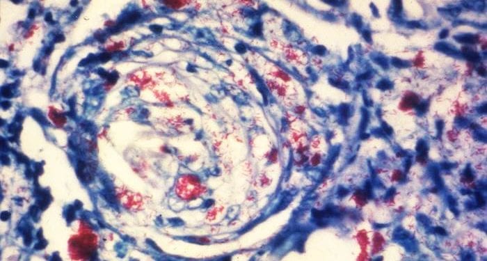 Photomicrograph of a skin tissue sample from a patient with leprosy reveals a cutaneous nerve invaded by numerous Mycobacterium leprae bacteria. Photo by Arthur E. Kaye, CDC