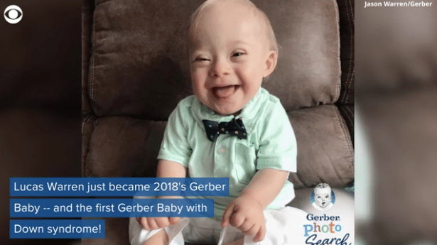 gerber baby with downs