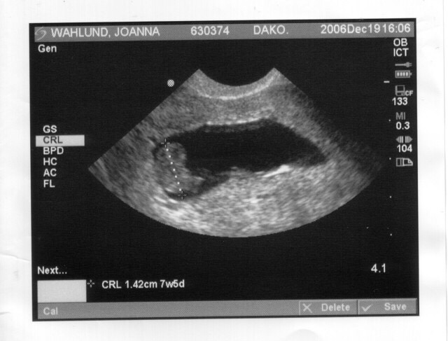 ultrasound miscarriage Noel