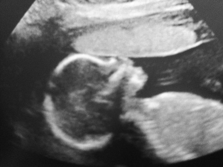 ultrasound