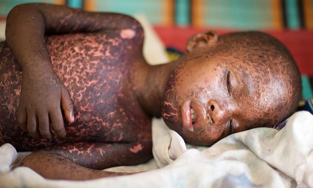 measles anti-vaccination texas religion