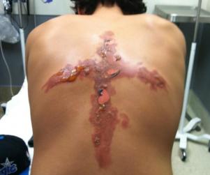 12-Year-Old Boy Burns Cross Into His Back (Graphic Image in Post)