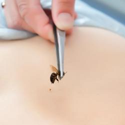 Woman Dies Due to Gwyneth Paltrow-Endorsed Bee Sting Acupuncture Treatment