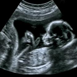 Christian Group to Show 4-D Ultrasounds in NYC as Part of Anti-Abortion Campaign